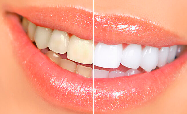 Blanqueamiento Dental