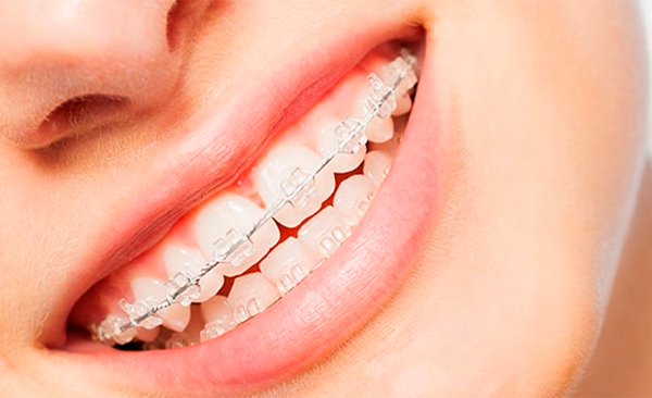Braquets esteticos
