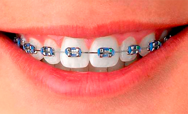 braquets-metalicos