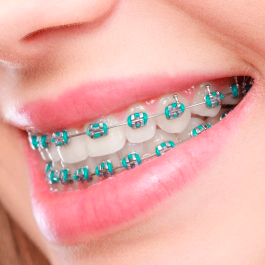 braquets-servicios