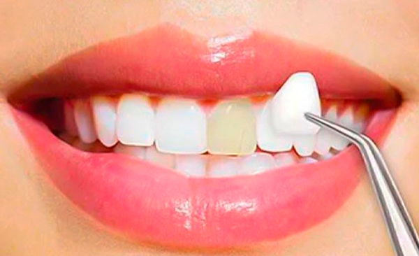Carillas Dentales
