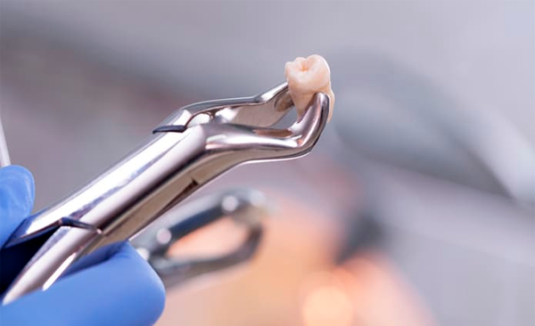 Extracciones Dentales