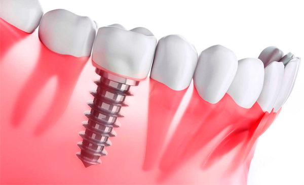 Implantes Dentales