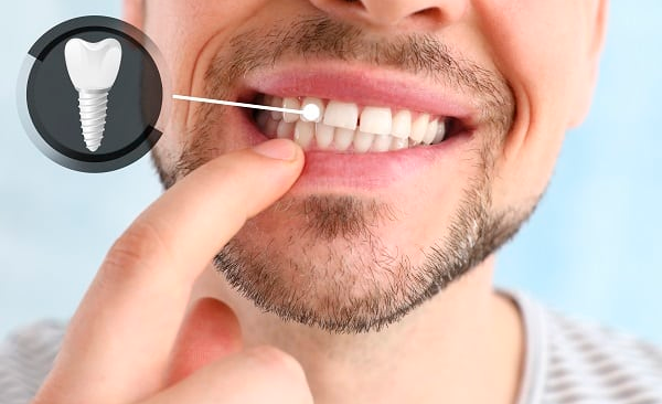 Implantes Dentales