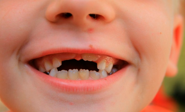 Traumas dentales